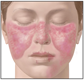 Systemic Lupus Erythematosus