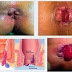 Obat Wasir Fargelin thumbnail