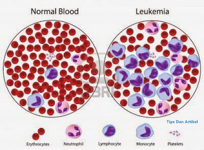 Gejala dan penyebab kanker Leukemia