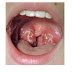 ABSES PERITONSIL