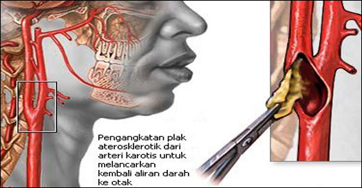 Cara Mengobati Stroke