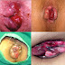 Obat Wasir Tradisional Stadium 3 dan 4 thumbnail
