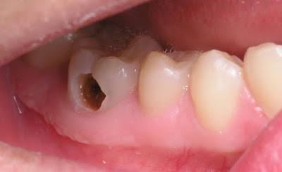 Răng sâu có bọc sứ được không?