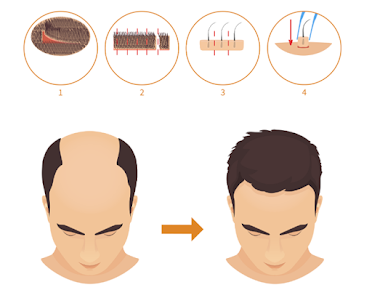 hair transplant in Bhubaneswar