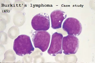 Case study (45) - Burkitt’s lymphoma