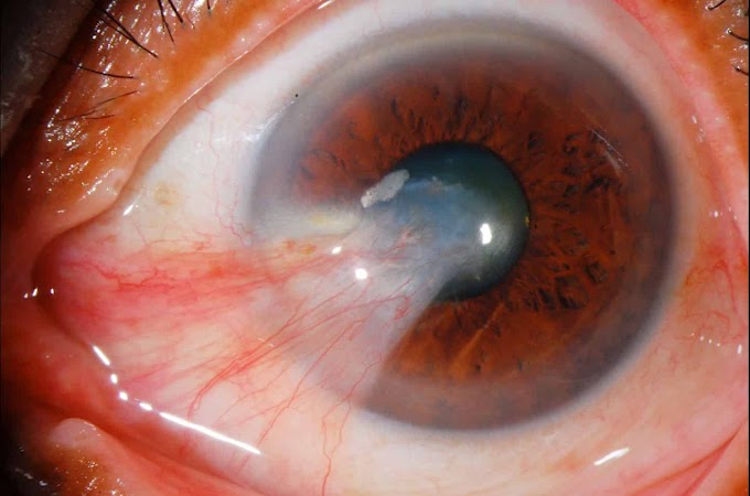 Short cases in ophthalmology