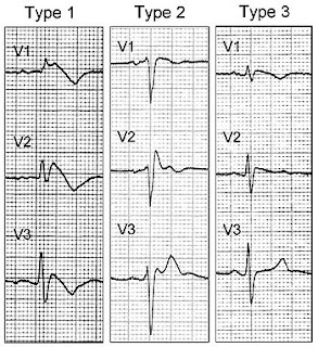 Brugada sendromu ekg