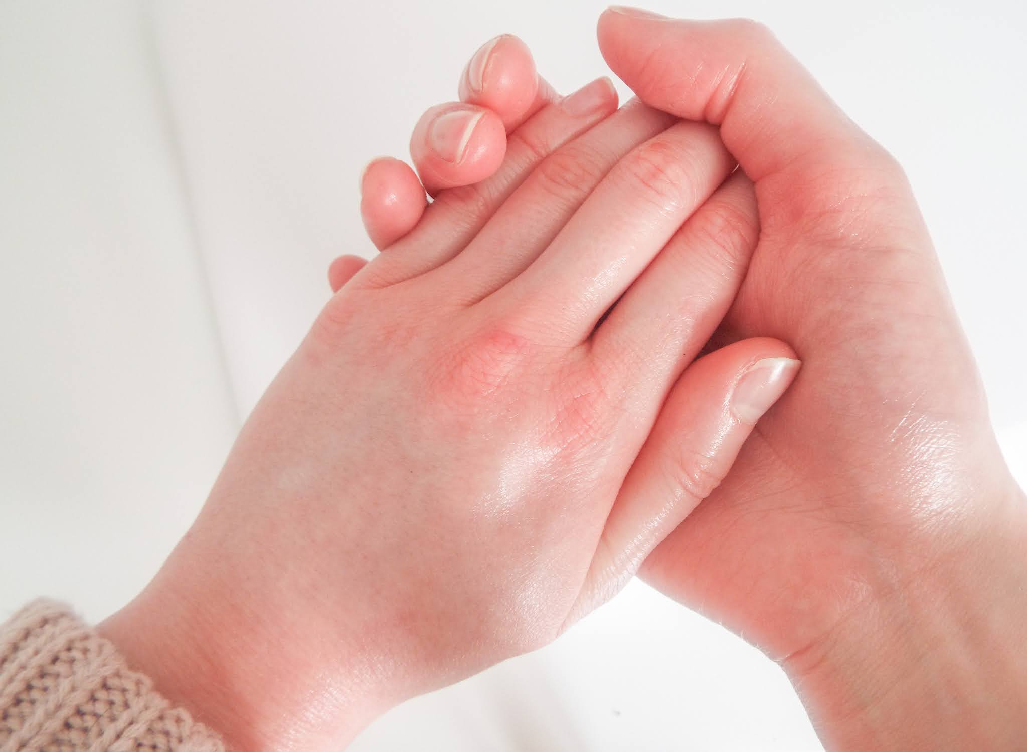 Picture of my healed sore, cracked hands, held hand in hand and looking supple and nourished.