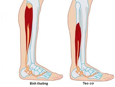 Nhận biết các dạng teo cơ như thế nào ?