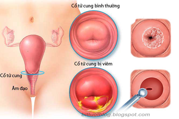 bieu-hien-benh-viem-co-tu-cung