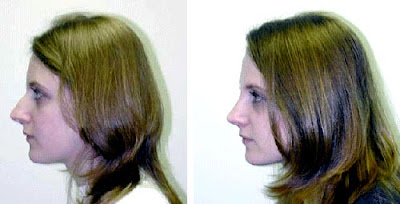 Rhinoplasty Before After