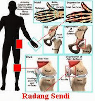 Obat Radang Sendi Alami