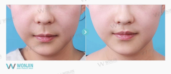 philtrum reduction