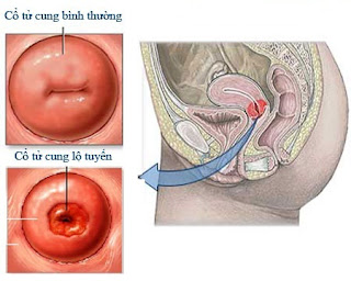 Dấu hiệu của viêm lộ tuyến cổ tử cung