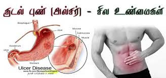 kudal pun tamil,kudar pun,kudal pun treatment in tamil,sariyaga,vayiru pun punnu marunthu tamil punnugu ulcer alcer vaithiyam nattu marunthu  remedies