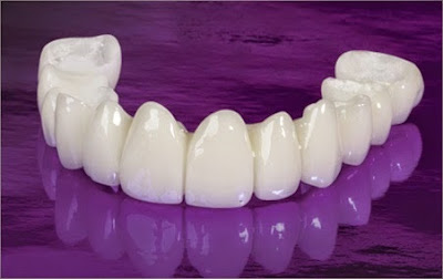 Các loại răng sứ cao cấp trong nha khoa