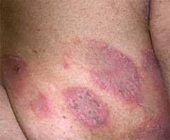 Overcoming eczema skin