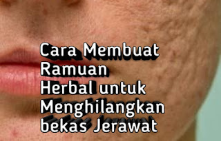 Cara Alami Menghilangkan bekas jerawat 100％ aman