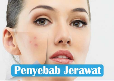 Apa Penyebab Munculnya Jerawat Pada Wajah