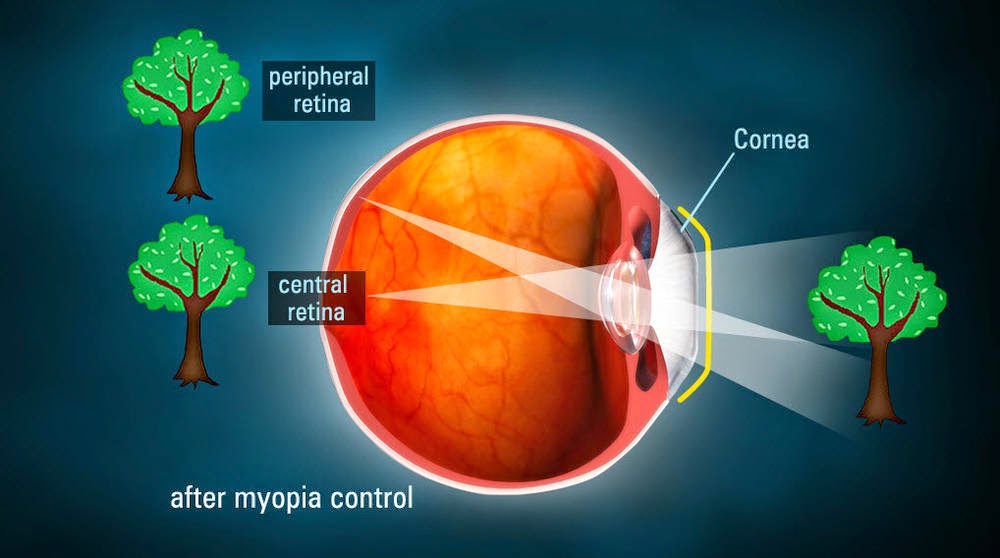 high-myopia-eye-hospital.com/myopia/