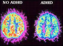 ADHD Study