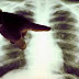 cancer poumon symptome - Informations générales sur