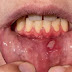 Oral Ulcer/Apthous Ulcer