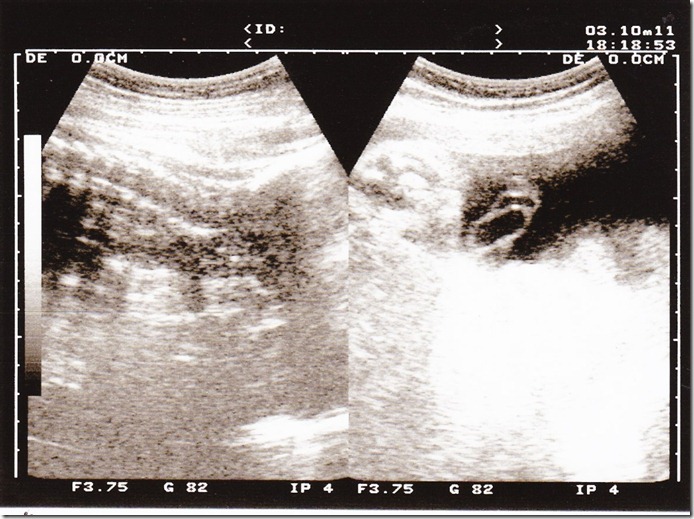 1001003_37weeks2days