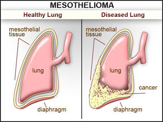 Mesothelioma, penyakit Mesothelioma