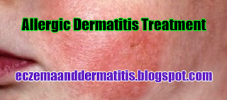 Allergic Dermatitis Treatment