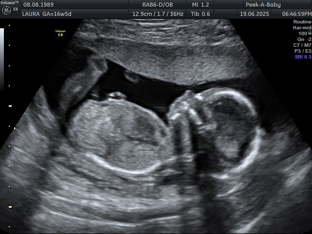 16 week gender scan boy