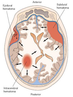 Hematoma subdural  y  epidural