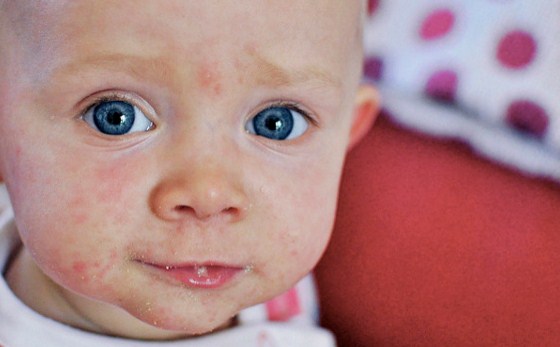 10 Rawatan Demam Campak untuk Bayi dan Kanak-kanak