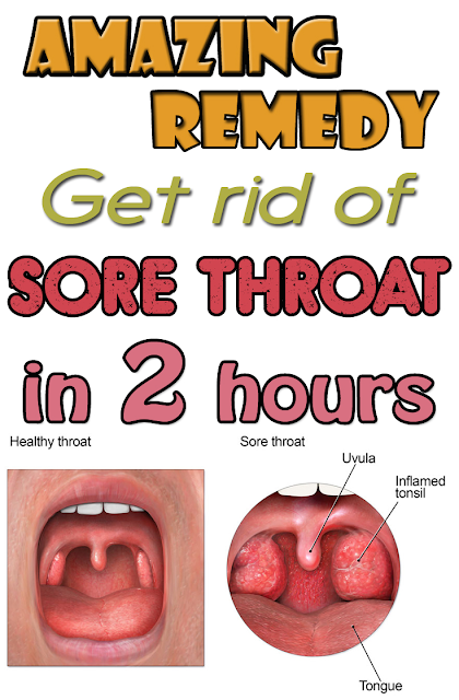 Amazing remedy. Get rid of sore throat in 2 hours