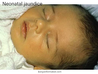 জন্ডিস কেন হয়? জন্ডিস হলে করনীয় কি? | Why does jaundice occur?  What to do if jaundice?