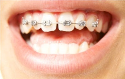Khi nào thì niềng răng không bắt buộc nhổ răng?