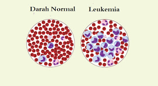 Leukimia penyakit pada sistem peredaran darah manusia