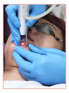 Acne Treatment di Lineation Bandung