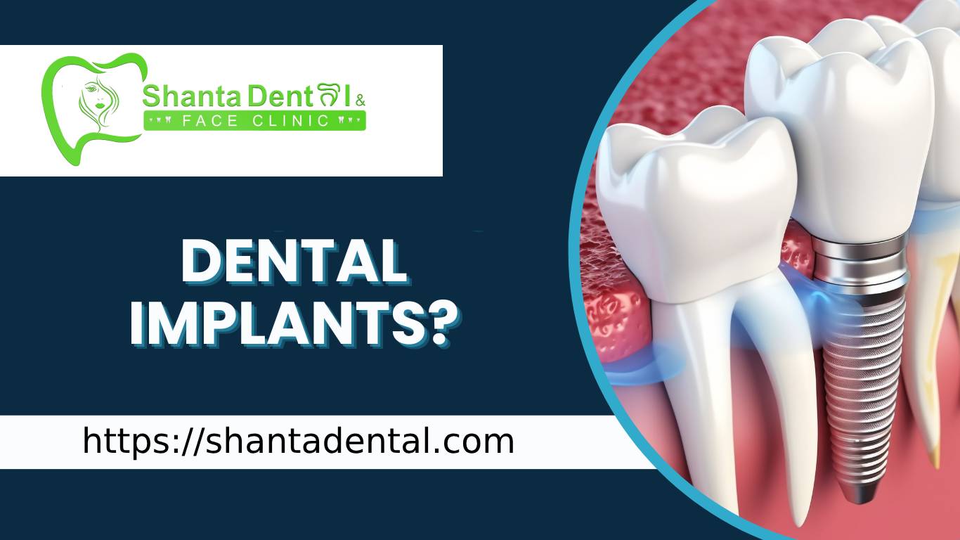 Dental Implant at Shanta Dental - Best Dental Clinic in Surkhet