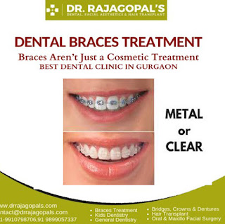 Braces Treatment in Gurgaon