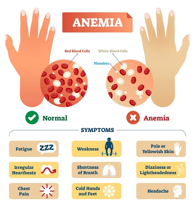 Anemia: Causes, Symptoms, and prevention through diet and supplementation 