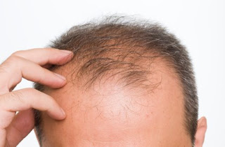 Tips to Overcome Baldness in Men