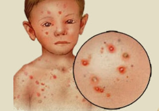 Is Monkeypox Virus Deadly