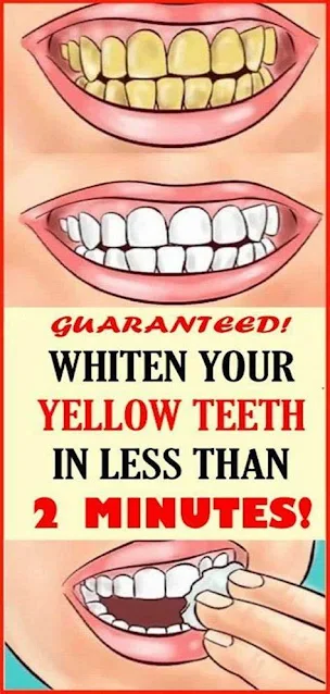 Guaranteed! Whiten Your Yellow Teeth In Less Than 2 Minutes!