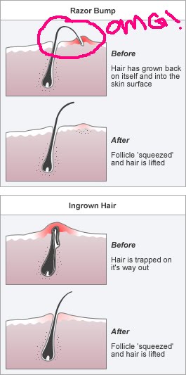 ingrown hair