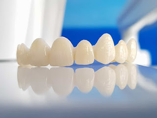 Các loại răng sứ cao cấp Các loại răng sứ cao cấp-2