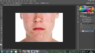 Cara-Menghilangkan-Jerawat-Dengan-Photoshop-cs6