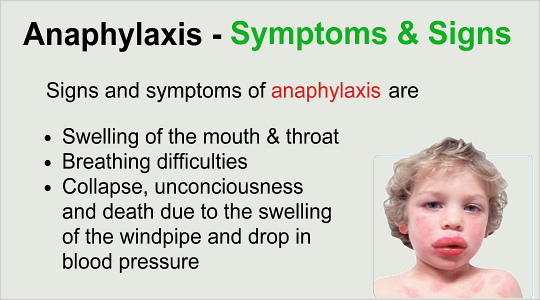 Symptoms And Signs Of Anaphylaxis