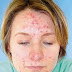 Don't Believe These Acne Myths