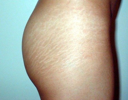  Ternyata ini Cara Praktis Menghilangkan Stretch Mark Cara menghilangkan stretch mark secara alami ketika hamil putih di paha